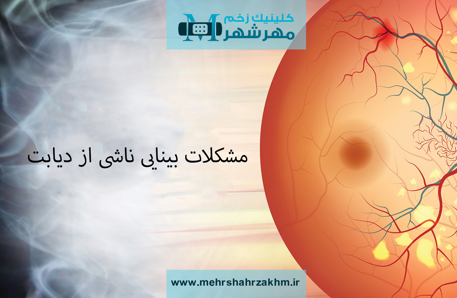 تاثیر و عوارض دیابت بر بینایی و میدان دید