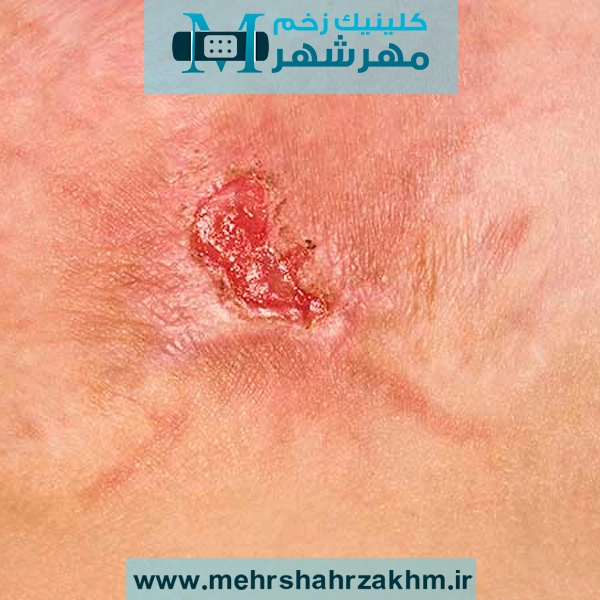 رابطه بین عفونت استاف و دیابت