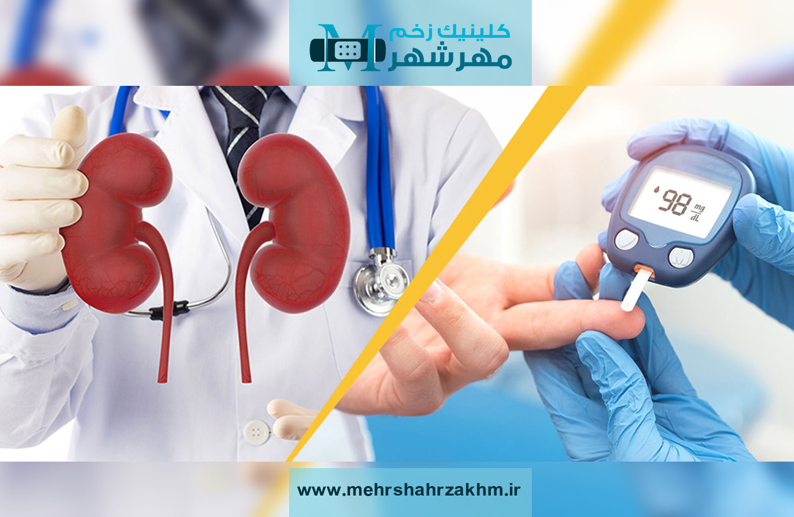 تاثیر دیابت بر بیماری های کلیوی | بیماری های کلیوی ناشی از دیابت