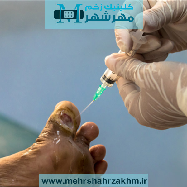 نحوه شستشو زخم پای دیابتی برای جلوگیری از عفونت