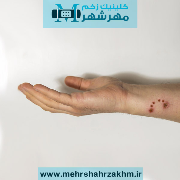 زخم گاز گرفتگی سگ را چطور درمان کنیم؟