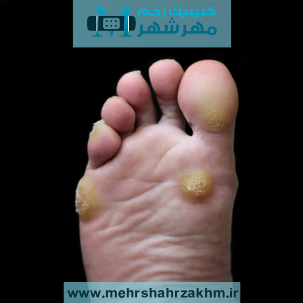 علت بروز پینه پای دیابتی چیست و چطور درمان می‌شود؟