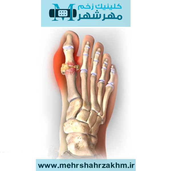 راه‌های درمان دیابت و نقرس و ارتباط میان آن‌ها