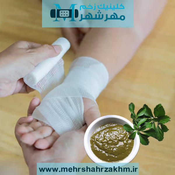 حنا برای زخم پای دیابتی