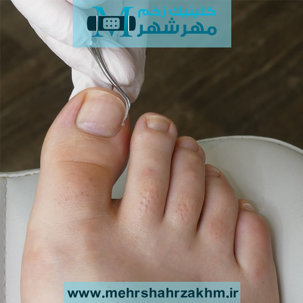 فرو رفتن ناخن در گوشت | درمان خانگی و پزشکی