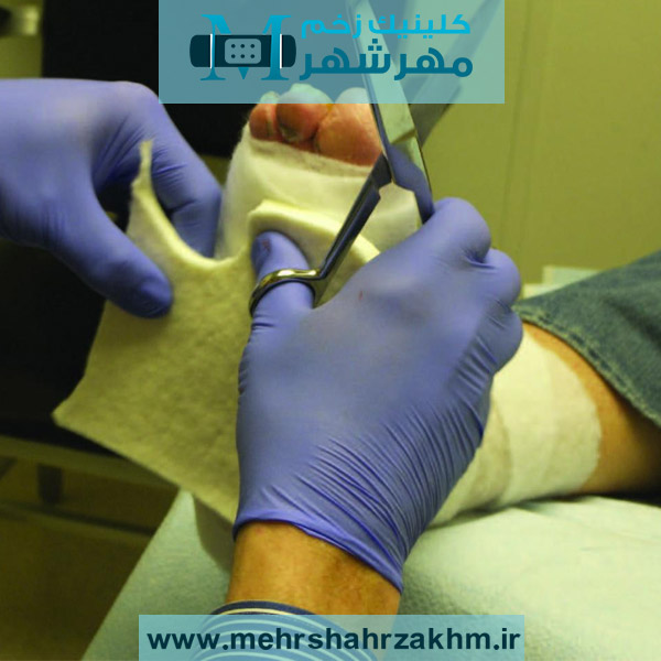 آفلودینگ یا کاهش فشار روی زخم پای دیابتی