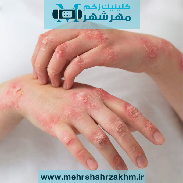 پسوریازیس درمان می‌شود؟