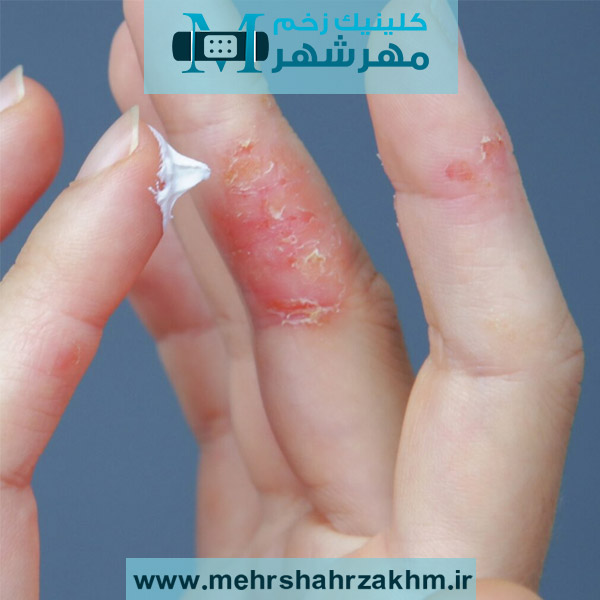 اگزمای پوستی چیست و چه درمانی دارد؟