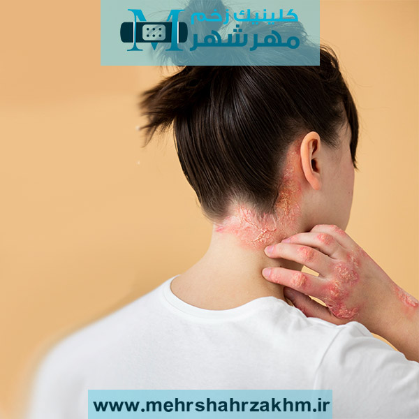 راه‌های پزشکی و خانگی درمان قارچ پوستی