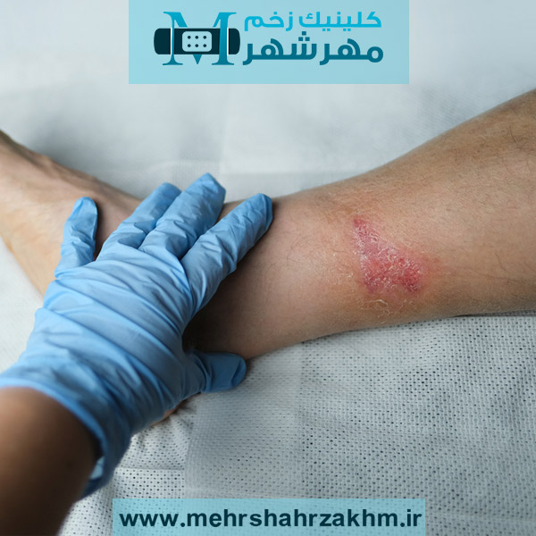 درمان عفونت زخم بخیه در بهترین کلینیک زخم کرج