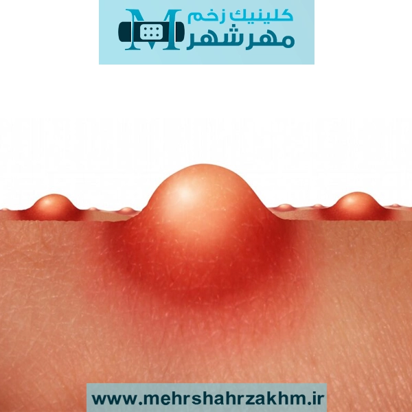 بیماری کربونکل یا کفگیرک درمان دارد؟ علائم + علت