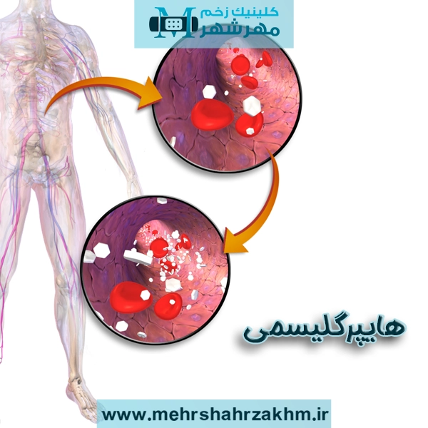 هایپرگلیسمی یا بالا رفتن قند خون چیست؟
