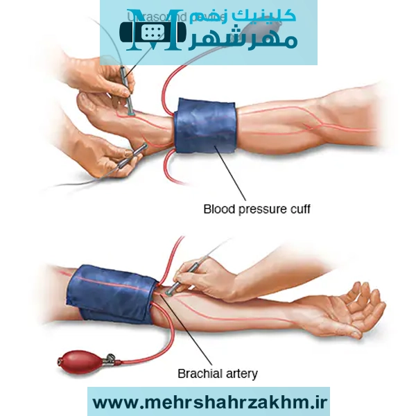 نحوه انجام تست ABI در خانه و کلینیک