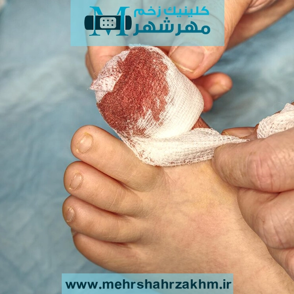 چرا برخی زخم‌ها خوب نمی‌شوند؟ دلایل و درمان