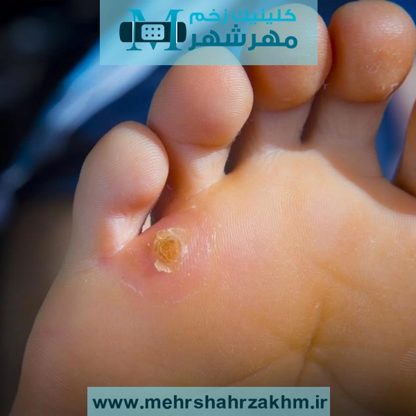 درمان قطعی میخچه با تجهیزات پیشرفته در کرج