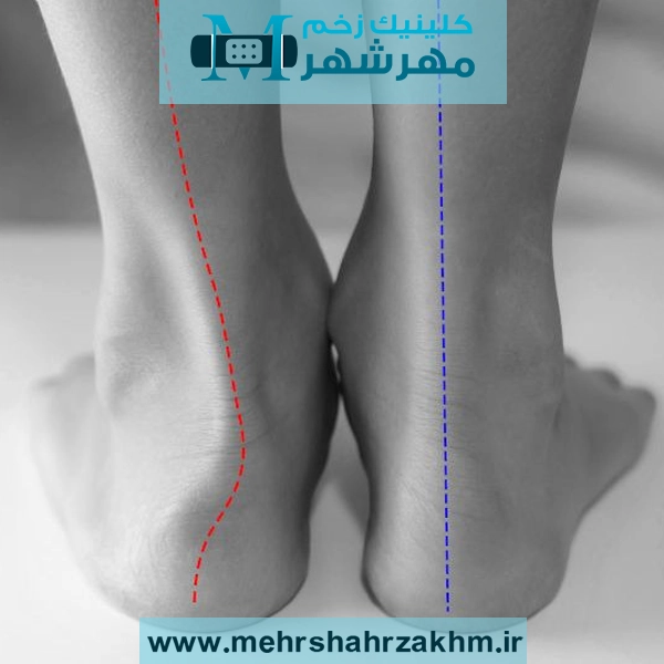 کف پای صاف ارثی است یا اکتسابی؟ آیا باعث زانودرد می‌شود؟
