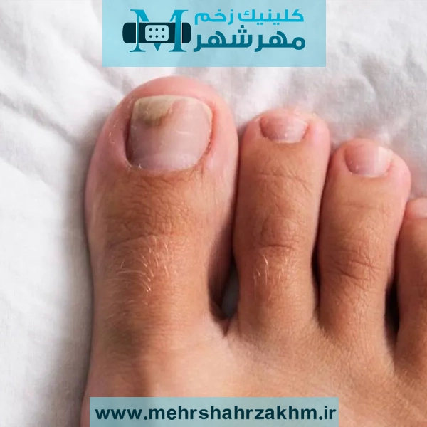 قارچ ناخن پا چیست؟ علائم+ علت+ درمان قطعی