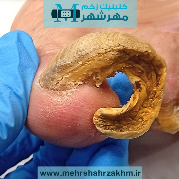 ناخن شاخ قوچی 🦶از علت، تا نحوه صحیح کوتاه کردن