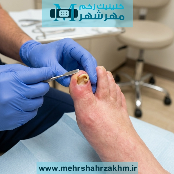 ناخن گاز انبری چیست؟ می‌توان آن را در خانه درمان کرد؟