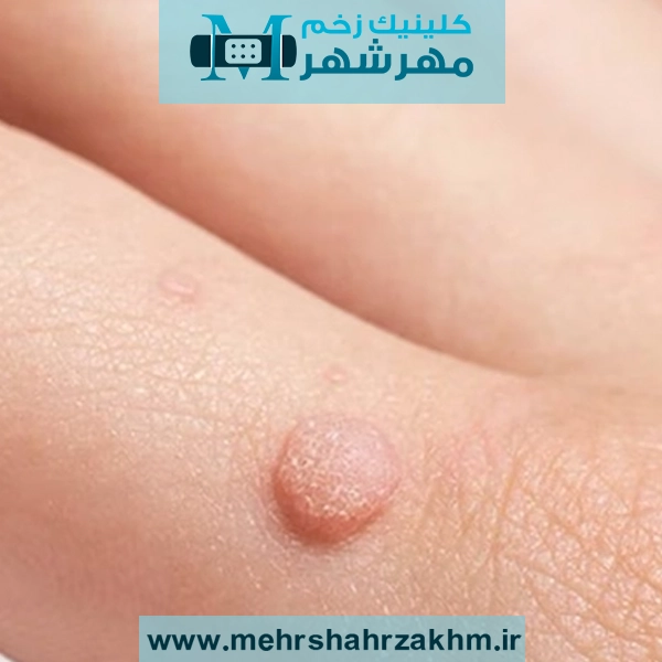 علت اصلی ایجاد زگیل پوستی در بدن و راه درمان آن