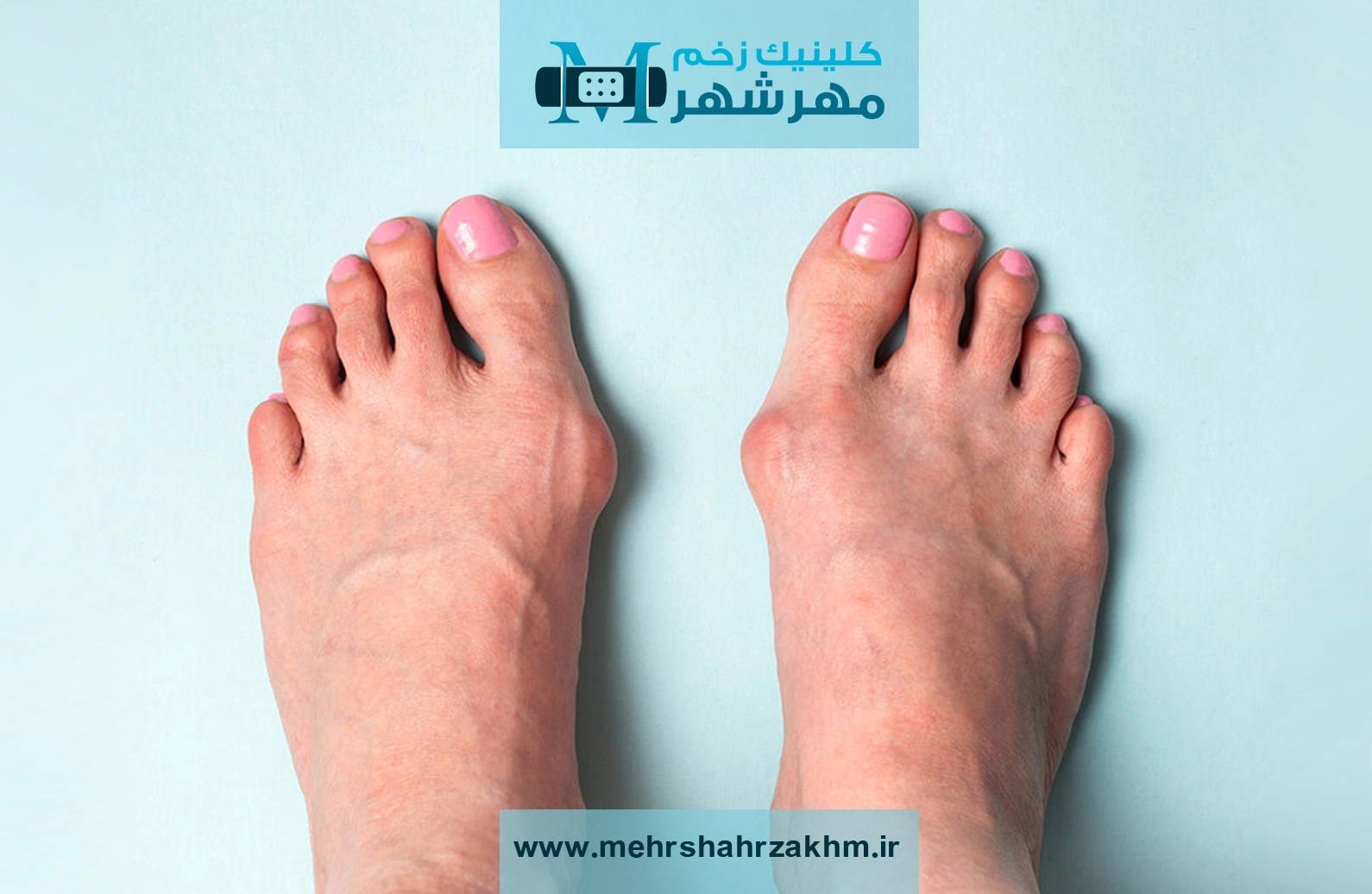 علت ایجاد هالوکس والگوس چیست؟