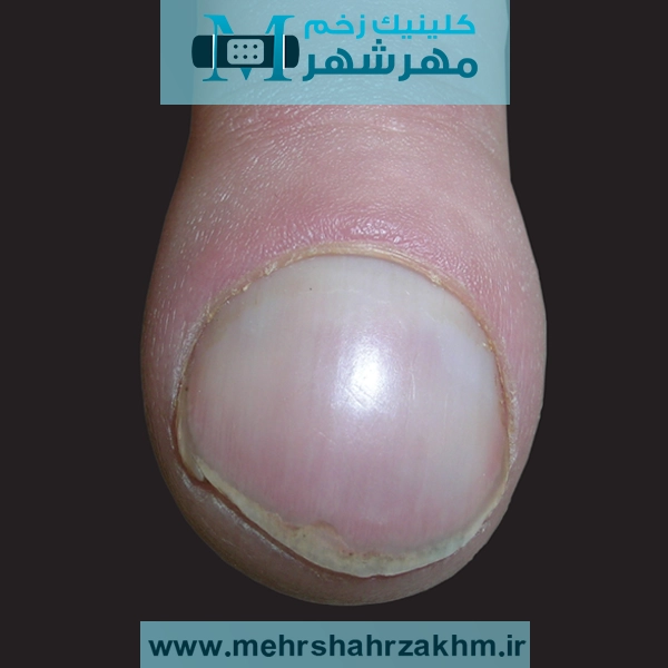 چماقی شدن ناخن و ارتباط آن با بیماری‌های کلیوی و ریوی