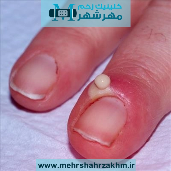علائم، علت‌ها، روش‌های تشخیص و بهترین درمان‌های پارونیشیا